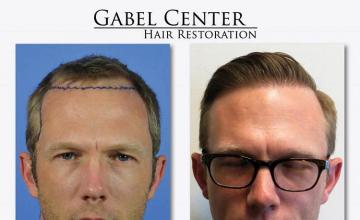 Hair restoration procedure before and after results