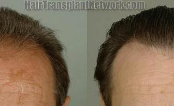 Hair transplantation surgery before and after images