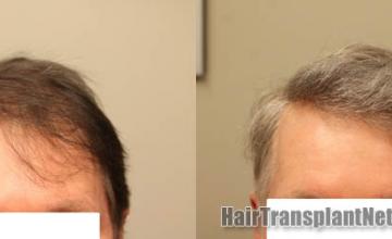 Front view - Before and after hair restoration procedure