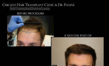 Before and after