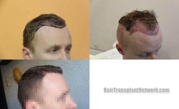 Hair transplantation surgery before and after photos