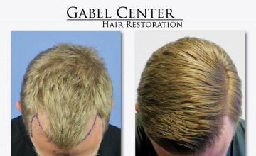 Hair transplantation surgery before and after photos