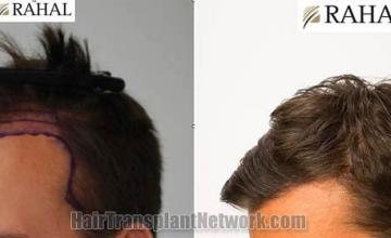 Hair transplantation surgery before and after images