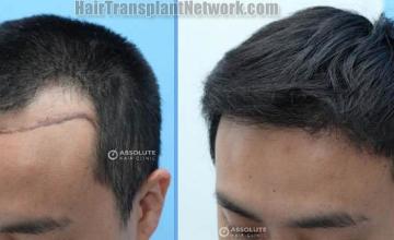  before and after result photographs