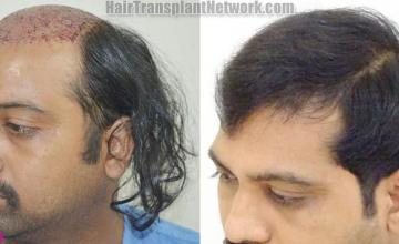  before and after result photographs