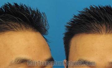 Hair restoration surgery before and after images