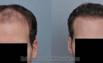 Before and after hair transplant procedure images