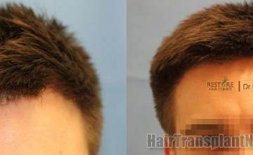 Hair transplantation surgery before and after images