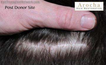 Hair restoration procedure before and after pictures