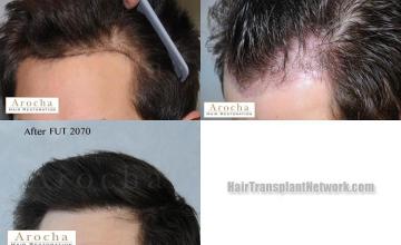 Hair transplantation surgery before and after pictures