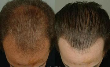 Hair transplantation surgery before and after pictures