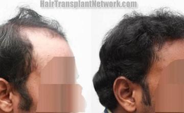 Hair transplantation surgery before and after photos