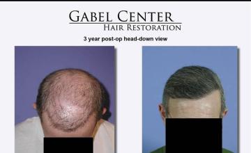 Top view before and after hair transplant repair