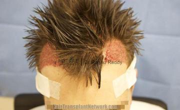 Hair transplantation surgery before and after pictures