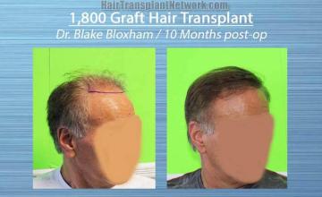 Hair restoration procedure before and after results