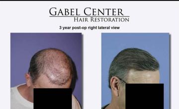 Before and after hair transplantation surgery