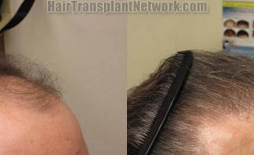  before and after images