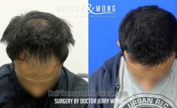 Hair transplantation surgery before and after images