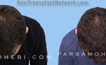 Hair transplantation surgery before and after images