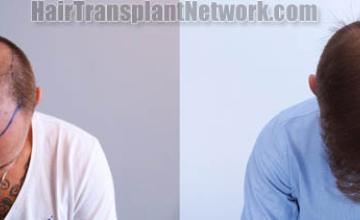 Hair transplantation surgery before and after images