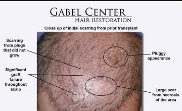 Initial hair transplant evaluation before surgery