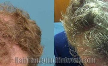 Before and after hair transplant procedure images