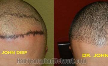 Top view - Before and after surgical hair replacement