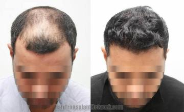 Before and after hair transplant procedure images