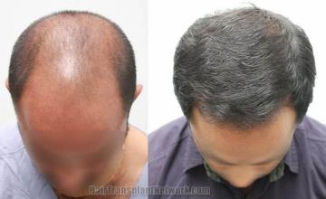 Top view - Before and after surgical hair replacement