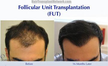Before and after hair transplantation result photographs