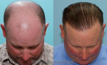 Hair restoration procedure before and after result photos