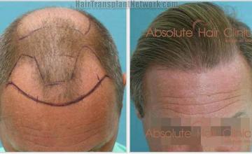 Hair restoration procedure before and after results