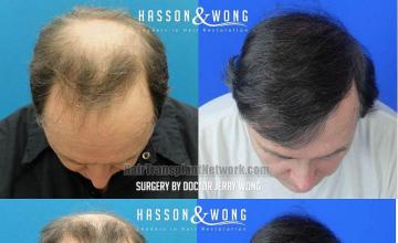 Hair transplantation surgery before and after images