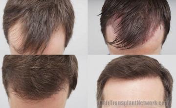 Hair restoration procedure before and after results