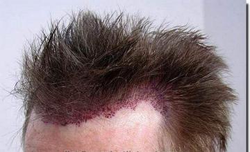 Hair restoration procedure results