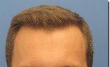 Hair restoration procedure results