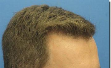 Hair restoration procedure results