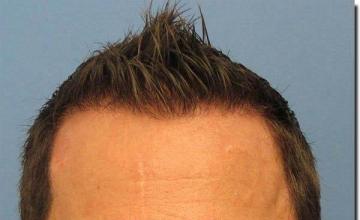 Hair restoration procedure results