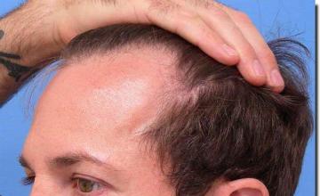 Hair restoration procedure results