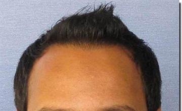 Hair restoration procedure results