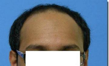 Hair restoration procedure results