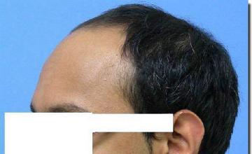 Hair restoration procedure results