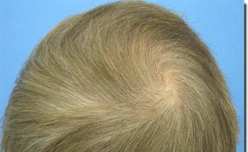 Hair restoration procedure results