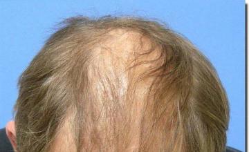 Hair restoration procedure results