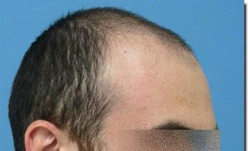 Hair restoration procedure results