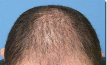 Hair restoration procedure results