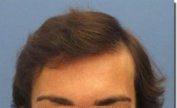 Hair restoration procedure results