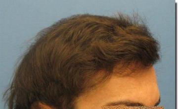 Hair restoration procedure results