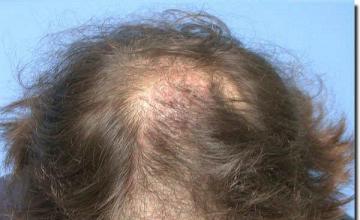 Hair restoration procedure results