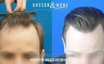 Before and after hair restoration procedure images